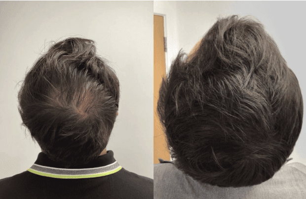 PRP Hair Restoration in Las Vegas: Natural Results at Revival Health