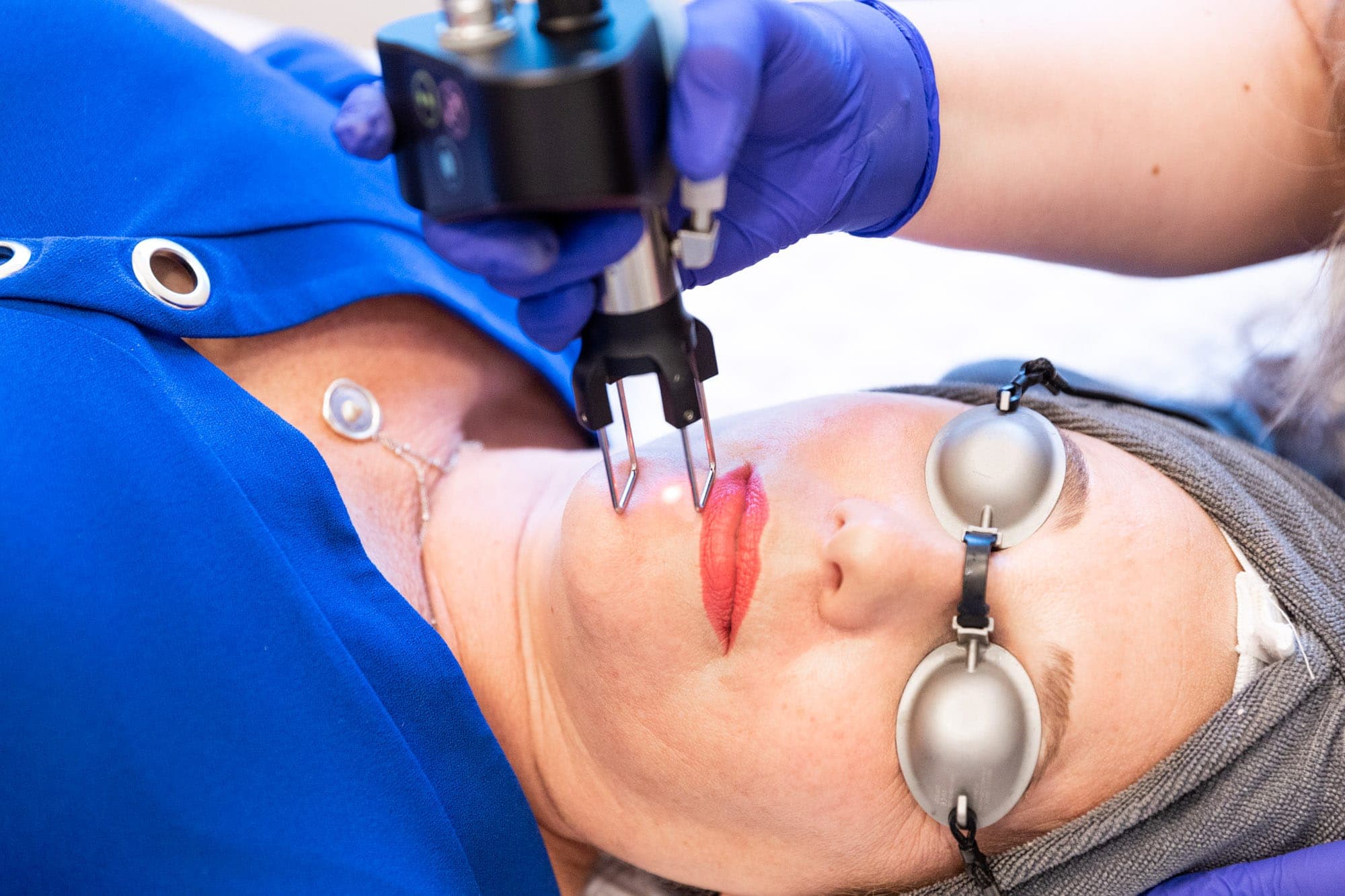 CO2 Laser Skin Resurfacing for Overton, NV residents