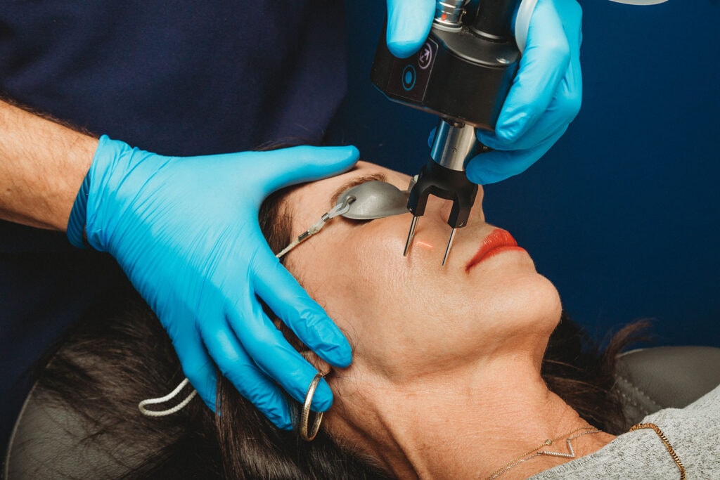CoolPeel® handpiece treating skin around the nose