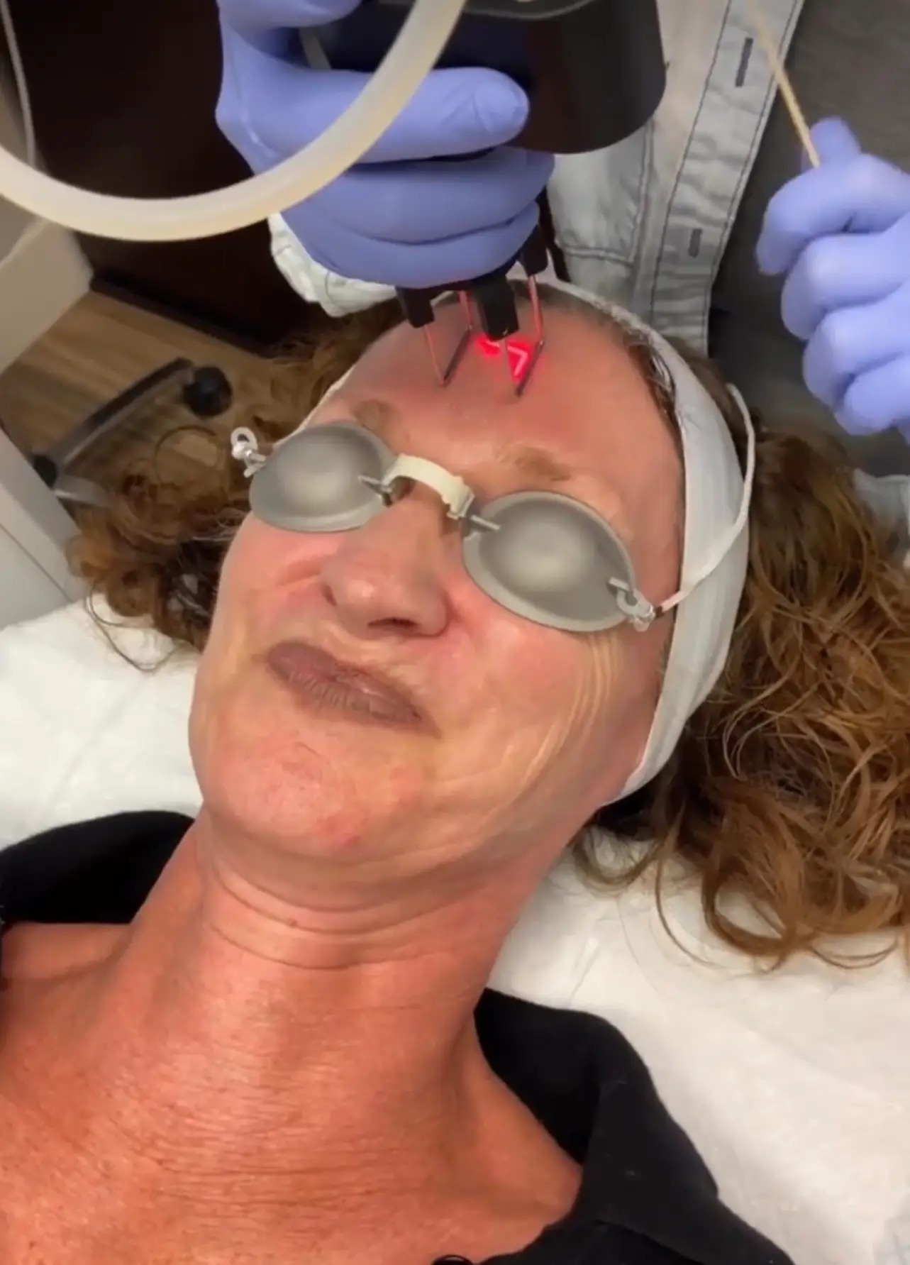 Patient wearing protective eyewear during CoolPeel® CO₂ laser session