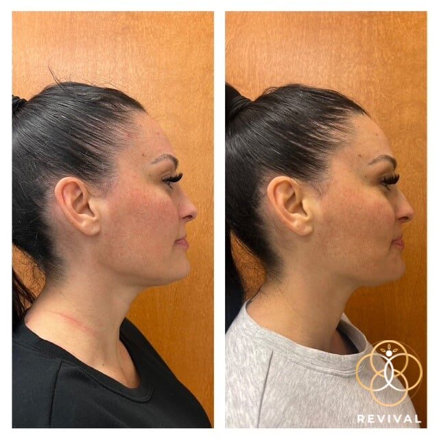 CoolPeel® CO₂ patient before and after 1