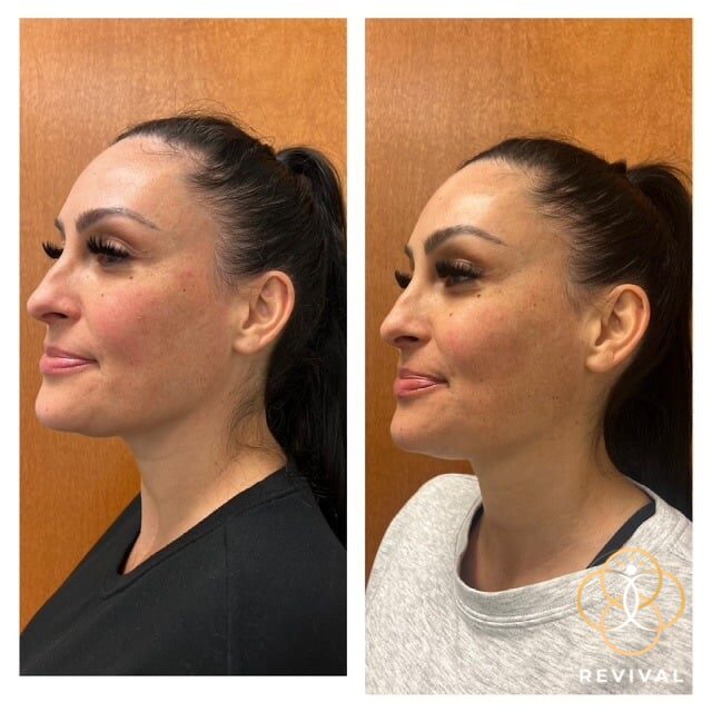 CoolPeel® CO₂ patient before and after 3