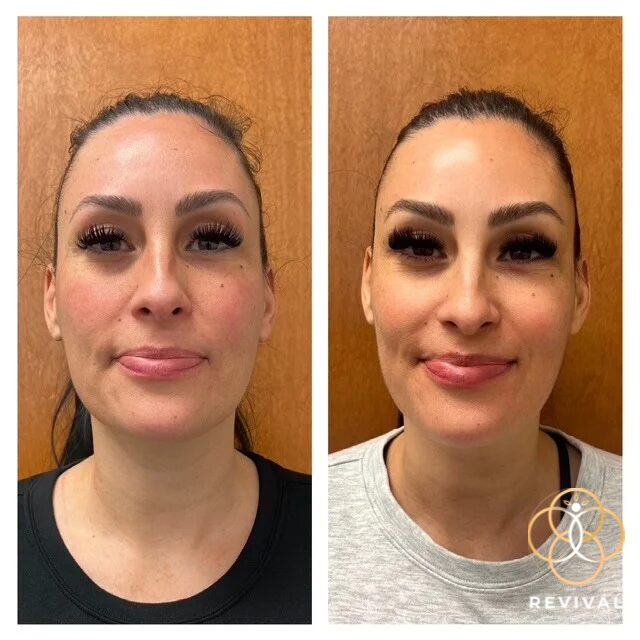 CoolPeel® CO₂ patient before and after 2