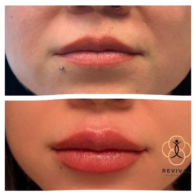 Derma filler patient before-and-after result 7
