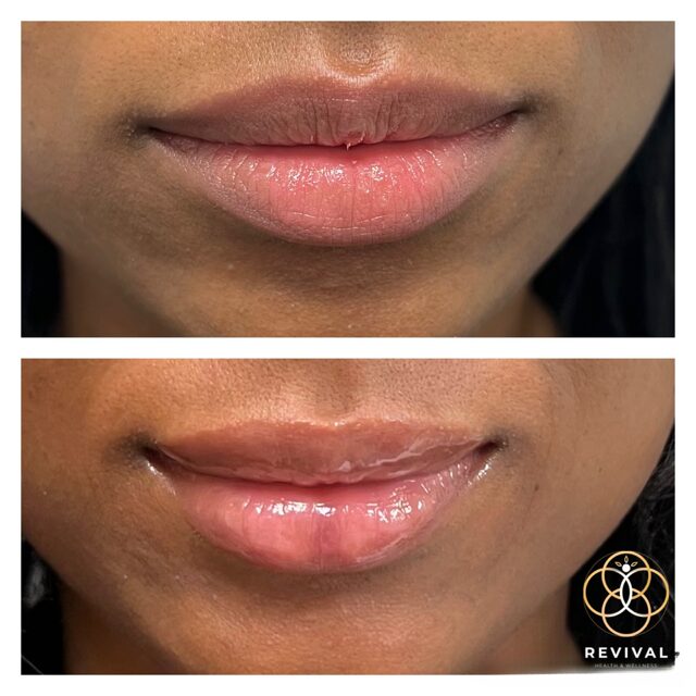Derma filler patient before-and-after result 5
