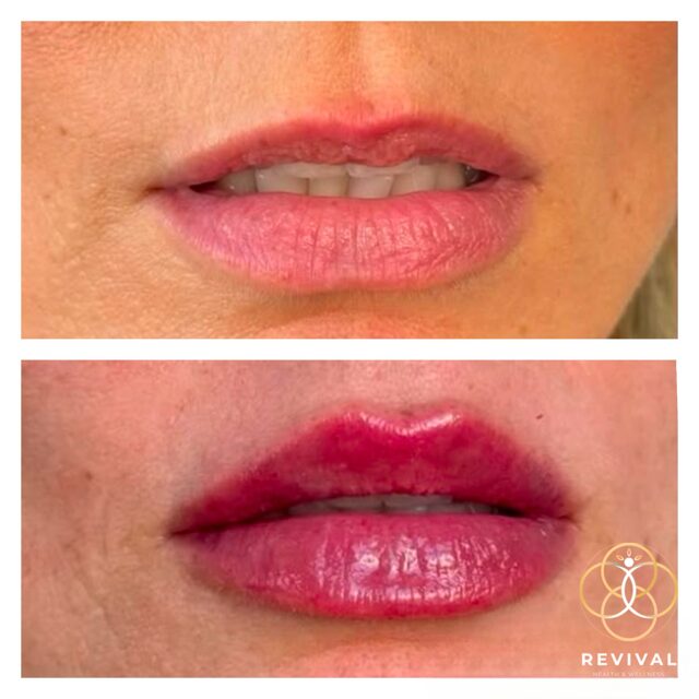 Derma filler patient before-and-after result 3
