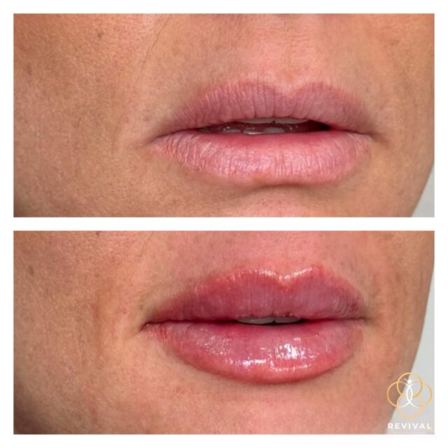 Derma filler patient before-and-after result 1