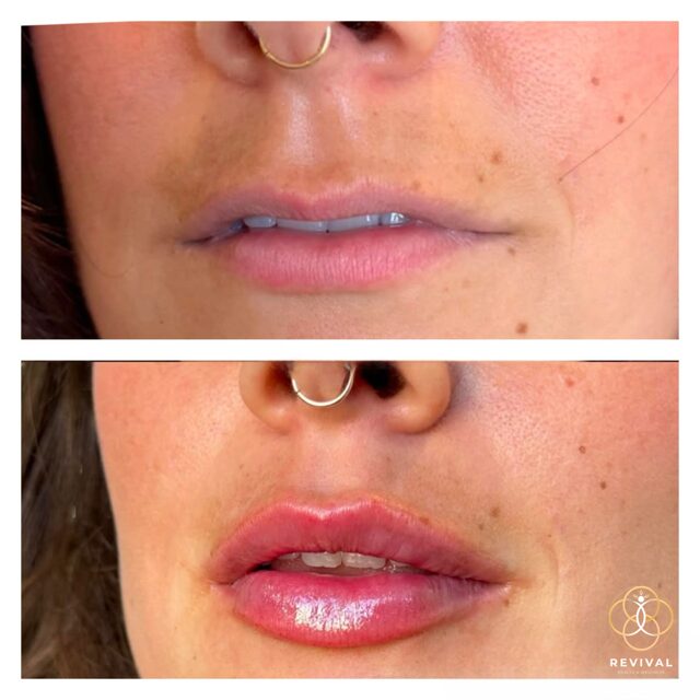 Derma filler patient before-and-after result 2