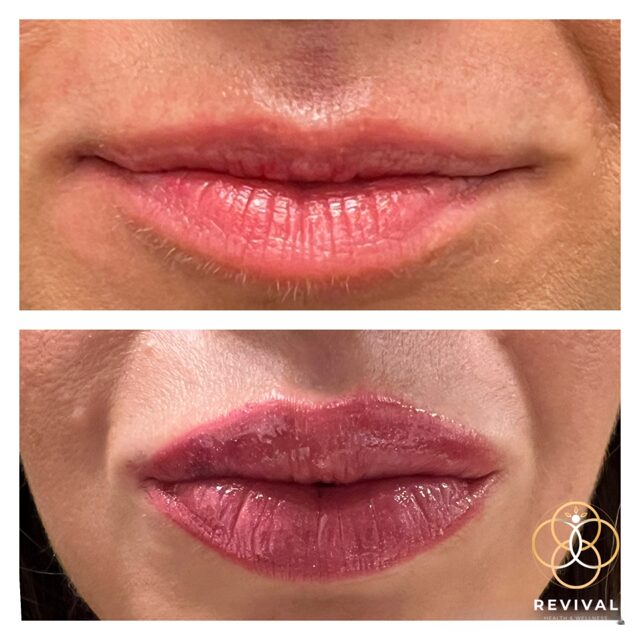 Derma filler patient before-and-after result 4