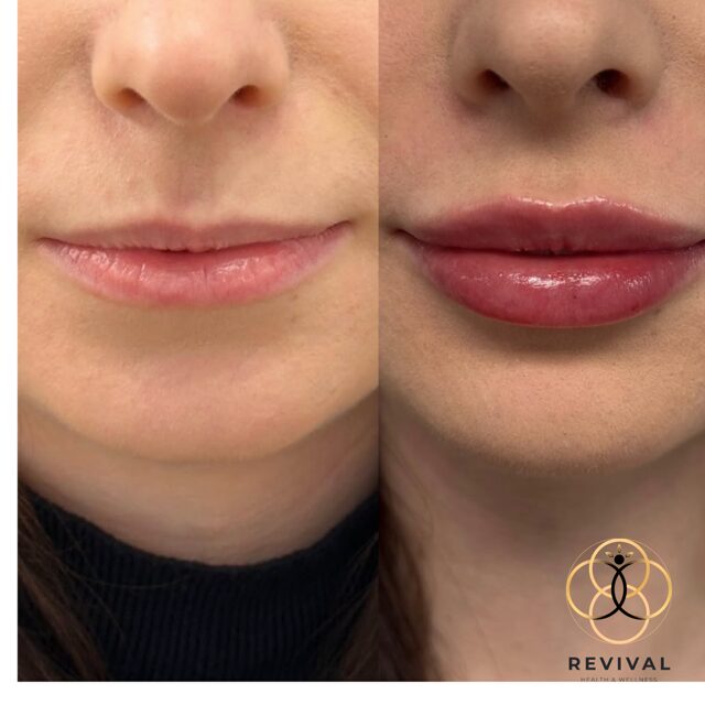 Derma filler patient before-and-after result 9