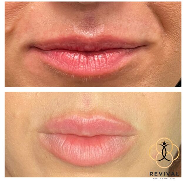 Derma filler patient before-and-after result 8