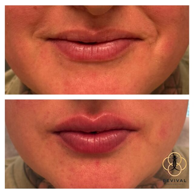 Derma filler patient before-and-after result 6