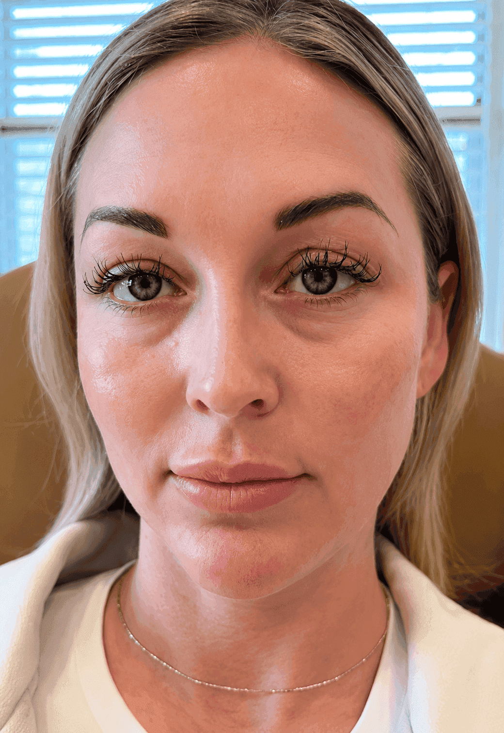 Before dermal filler treatment