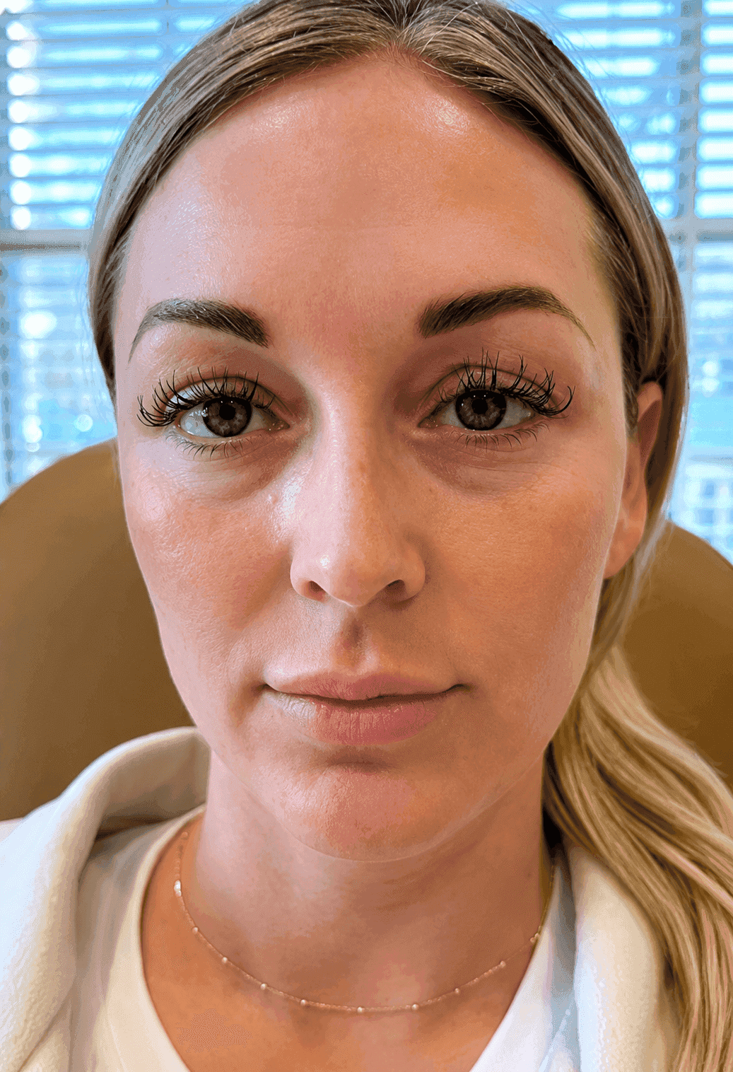 After dermal filler treatment