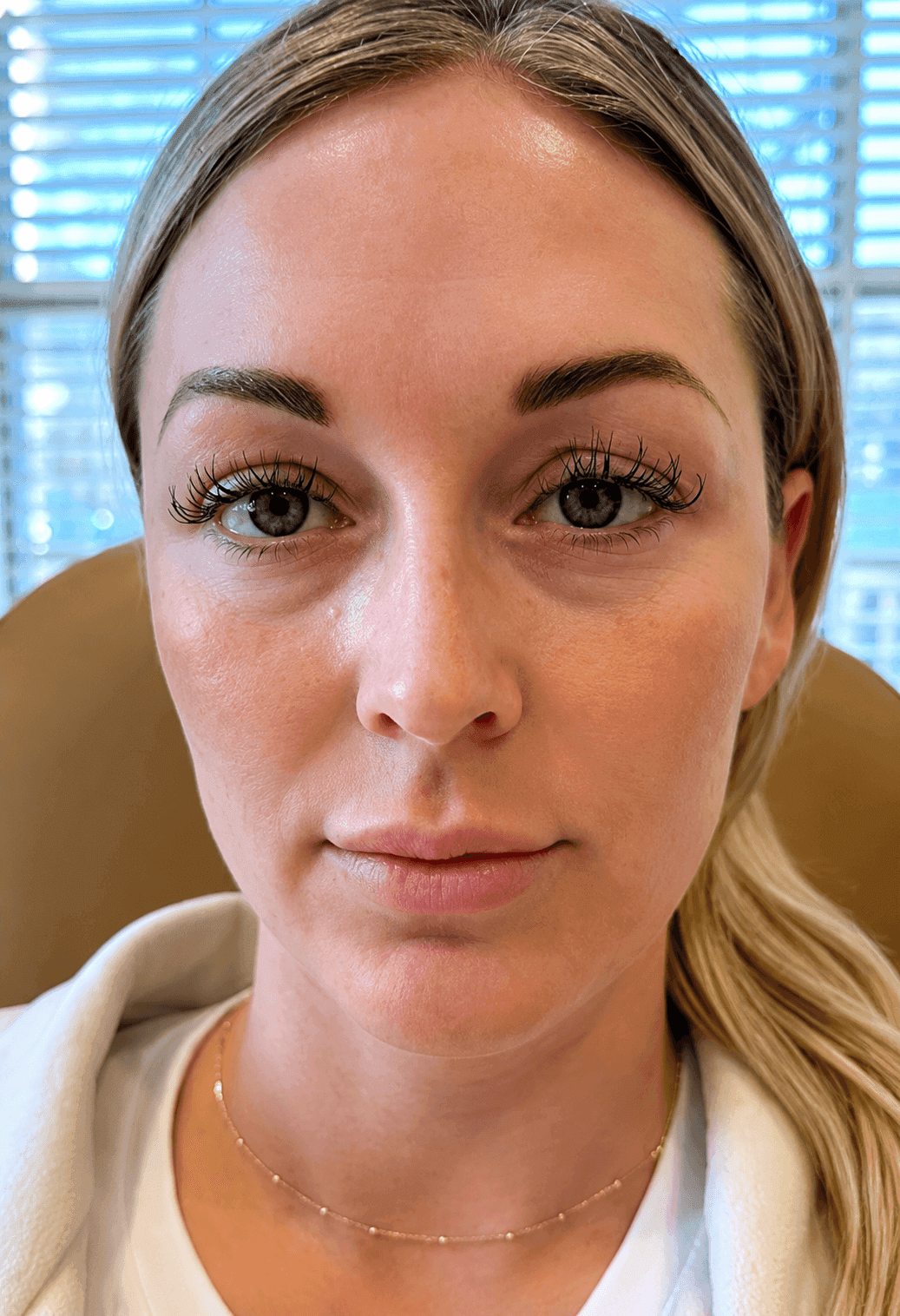 After dermal filler treatment