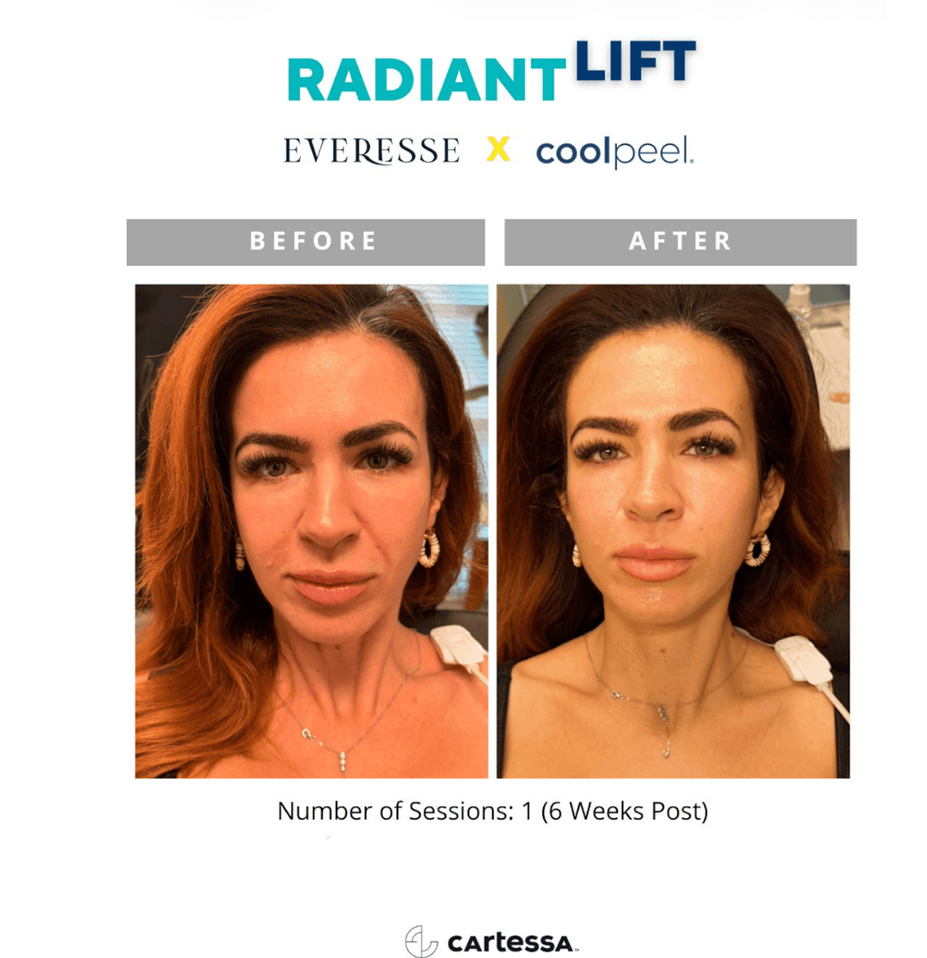 Everesse RF & CoolPeel patient before and after 1