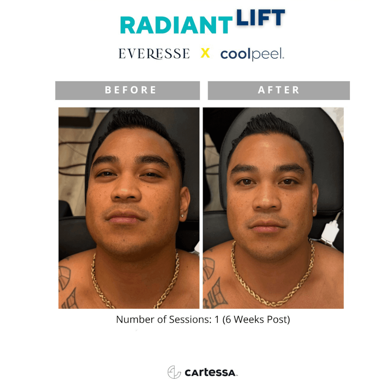 Everesse RF & CoolPeel patient before and after 2