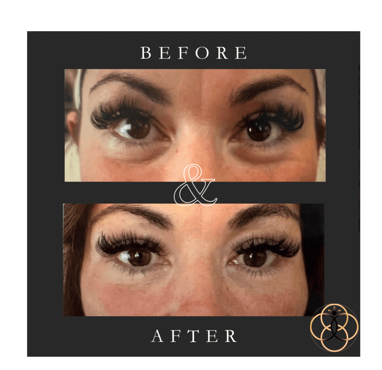 Everesse RF & CoolPeel patient before and after 3