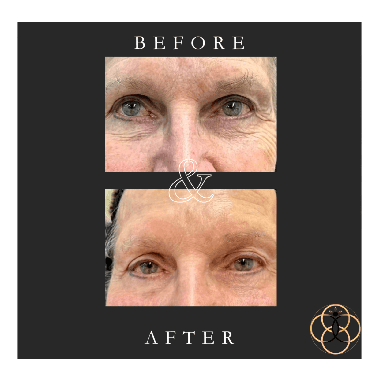 Everesse RF & CoolPeel patient before and after 4