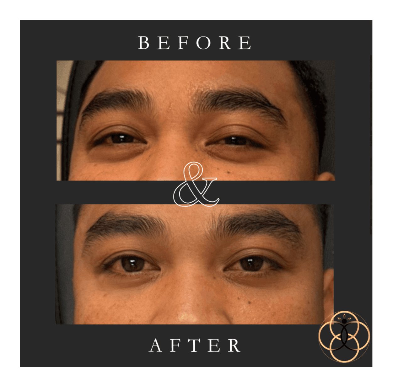Everesse RF & CoolPeel patient before and after 5