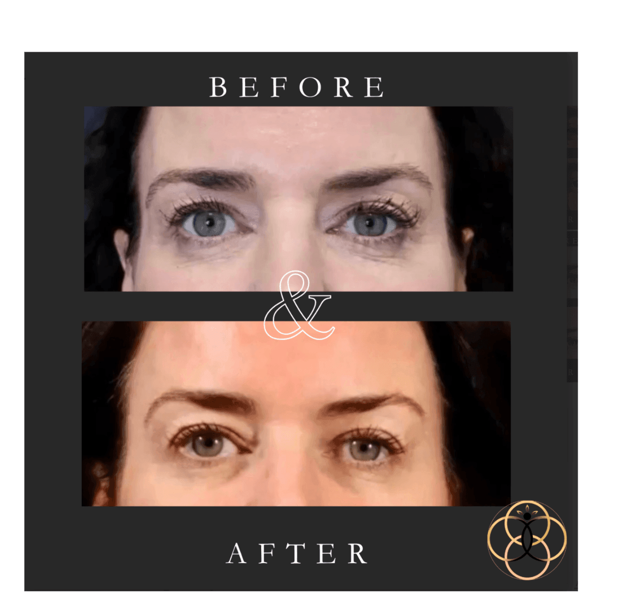 Everesse RF & CoolPeel patient before and after 6