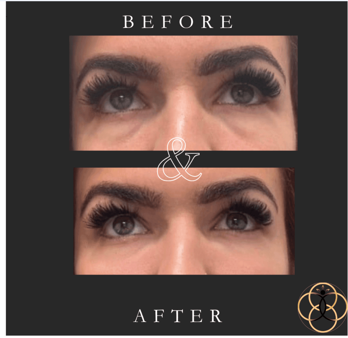 Everesse RF & CoolPeel patient before and after 7