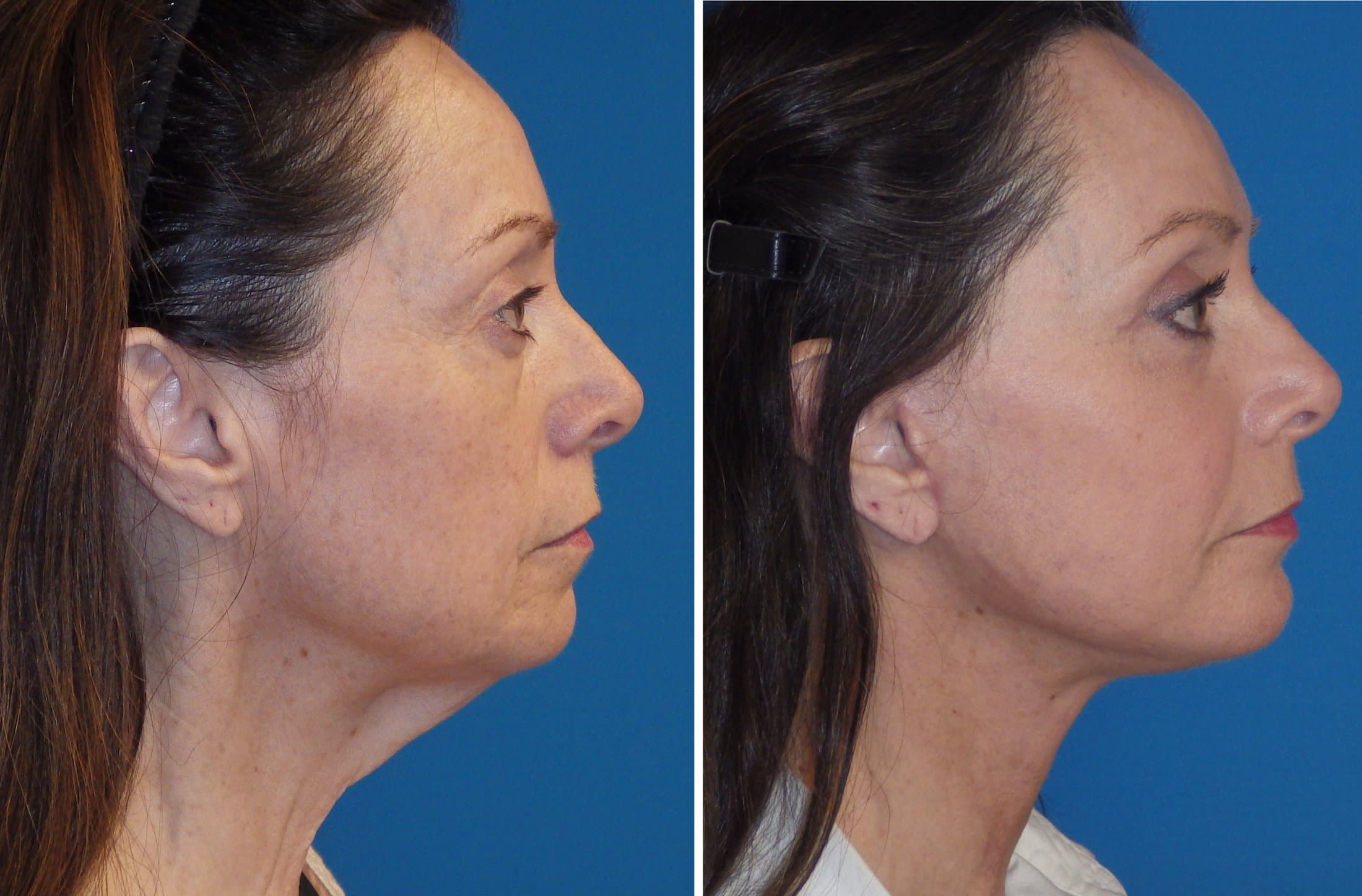 Kybella for Overton, NV residents