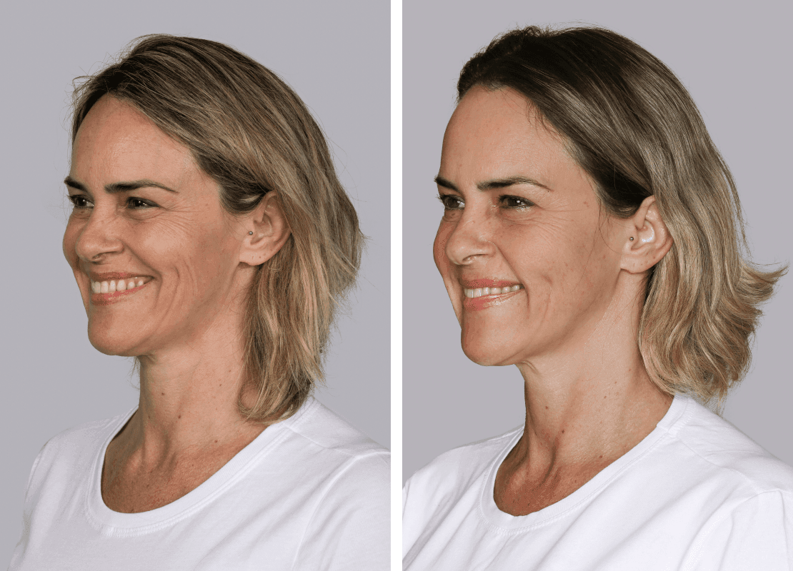 Sculptra® at Revival Health & Wellness