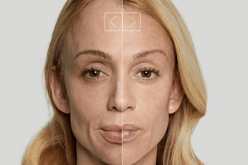 Sculptra for Overton, NV residents