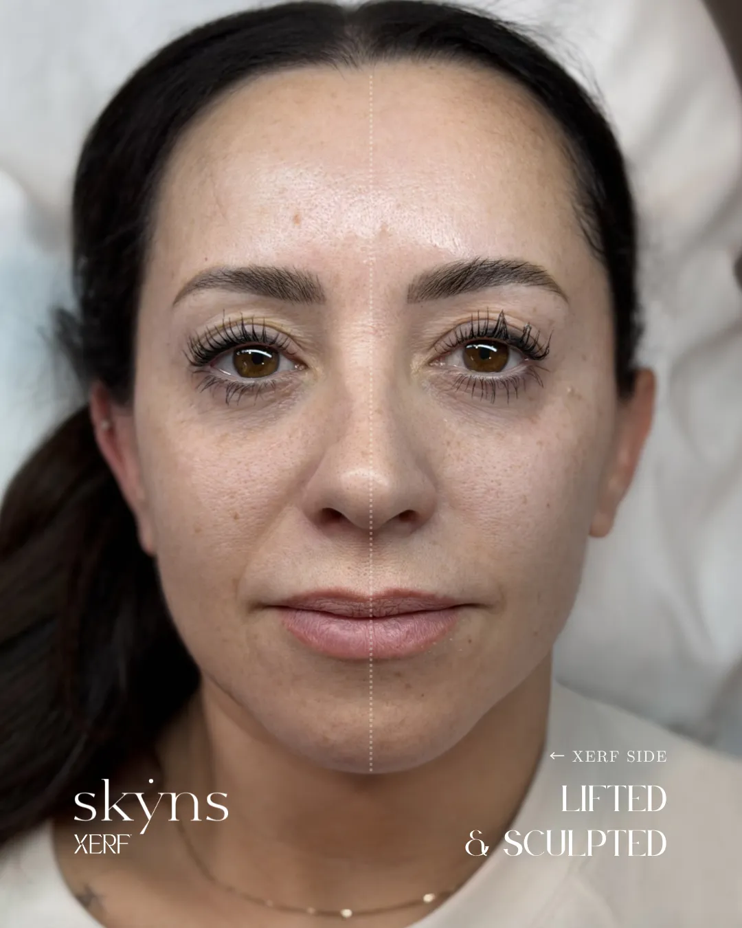 Xerf skin tightening - half-face treatment result