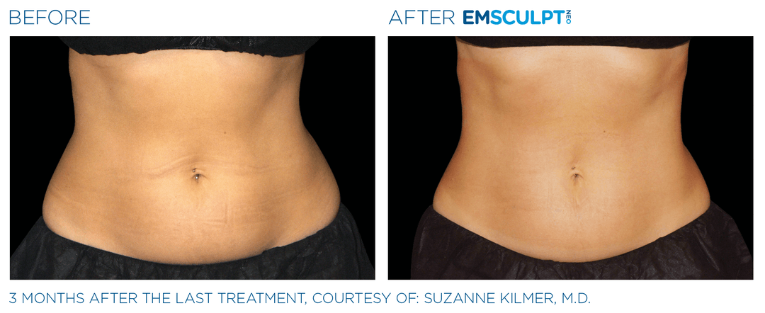Female abdomen before and after Emsculpt NEO treatment
