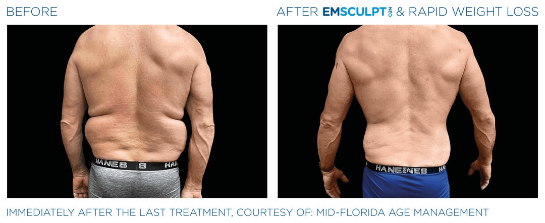 Male abdomen before and after Emsculpt NEO treatment